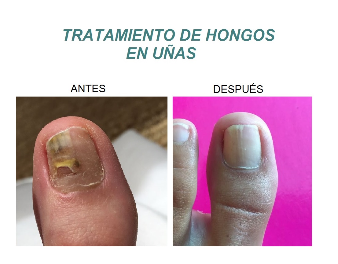 HONGOS EN UÑAS - Clínica Lucia Domingo Aguinaco